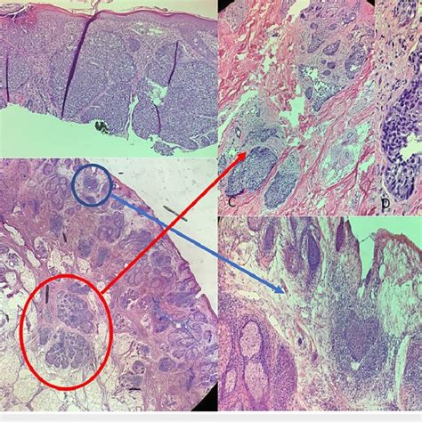 A Hematoxylin And Eosin Hande Stain 10x Original Biopsy Showing Basal