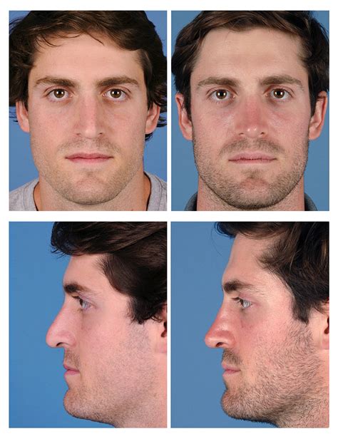 Male Rhinoplasty Before And After Photos