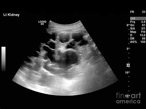 Polycystic Kidneys, Ultrasound Scan Photograph by Science Photo Library ...