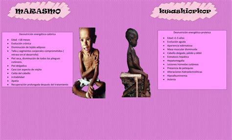 Marasmo Y Kwashiorkor Angelica Gandarilla Udocz