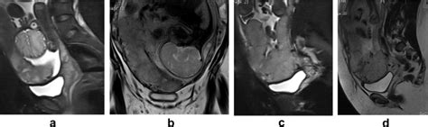 A Sagittal T2w Mr Image Of The Same Patient Revealed Complete Download Scientific Diagram