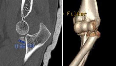 Fracture Luxation Du Coude Plexus Brachial Microchirurgie