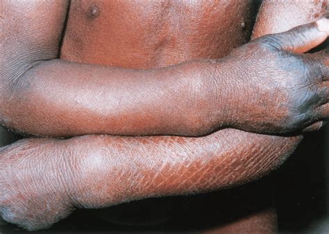 Lamellar Ichthyosis Treatment