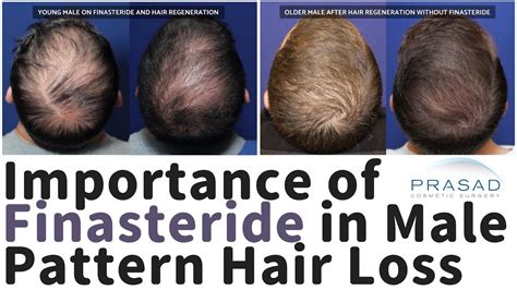 Share 134 Finasteride Male Pattern Hair Loss Poppy