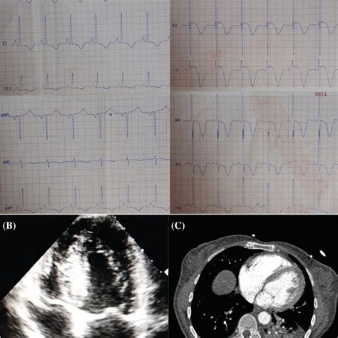 Noninvasive Imagings Of Paraaortic Paraganglioma A Whole Body Scan