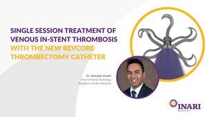 Single Session Treatment Of Venous In Stent Thrombosis With The New