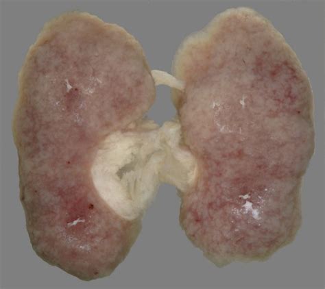 92. Pathogenesis of renal disorders caused by chronic arterial hypertension Flashcards | Quizlet