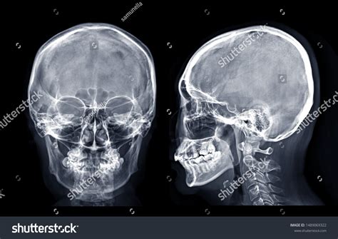 X Ray Skull