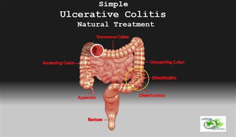 Simple Ulcerative Colitis Natural Treatment - Causes and Symptoms