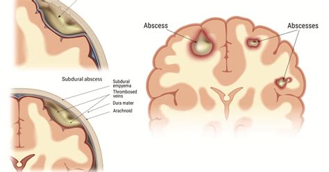 Stages Of Brain Abscess