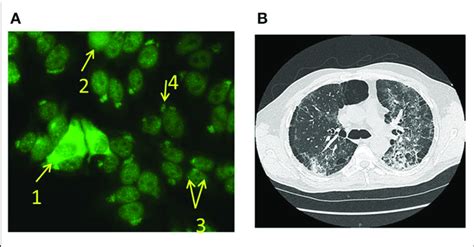 A Ana Aspect Of Case 1 Iif On Hep 2 180 Revealed Presence Of