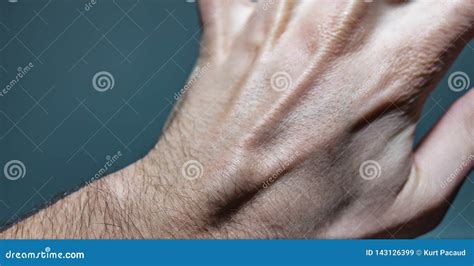 Ganglion Cyst Lump On Left Hand Stock Image Image Of Condition