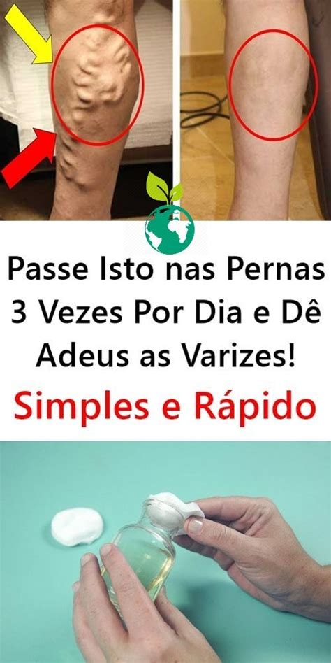 Receita Caseira Para Eliminar As Varizes Das Pernas