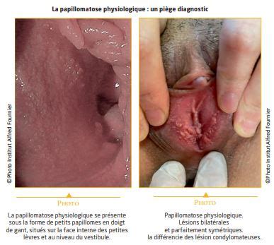 Mélanome Vulvaire Traitement Naturel Cancer de la Vulve