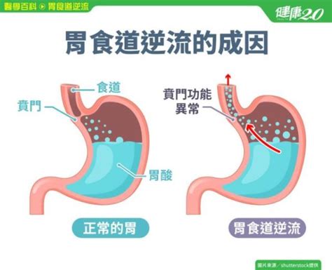 胃食道逆流的原因？常見胃食道逆流的類型？該怎麼緩解、預防及治療？ 生活大小事