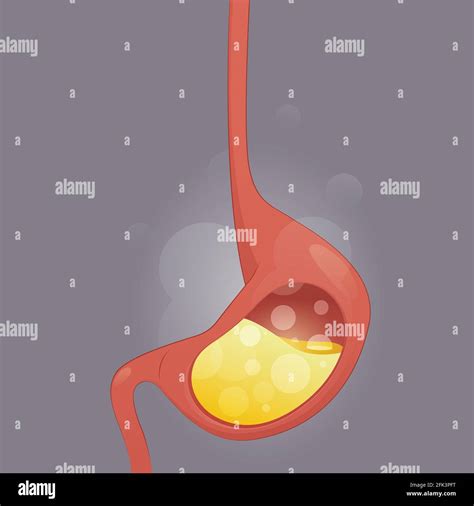 Gastro Sophageale Refluxkrankheit Saurer Reflux Sodbrennen Und Gerd