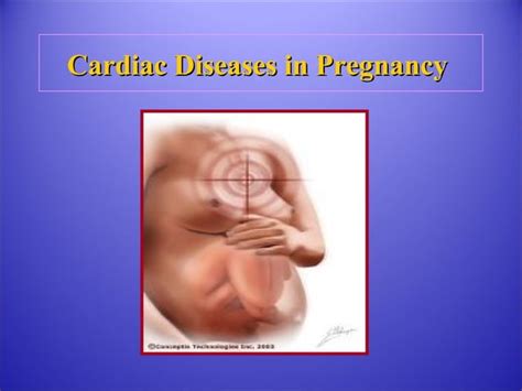 Cardiac Disease In Pregnancy Ppt