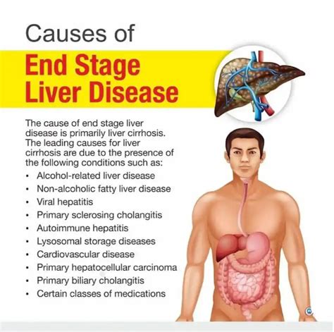 Stage 4 Liver Cancer Symptoms And What To Expect Anti Leukemia