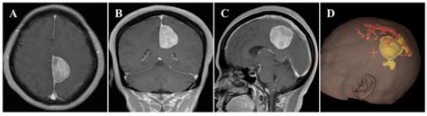 Endoscopic Ipsilateral Interhemispheric Approach For Middle Third