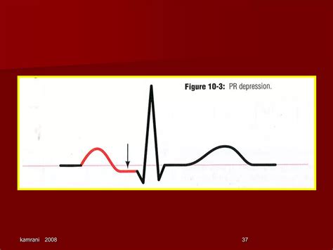 Parameters Of Ekg Interpretation 2 Ppt Free Download