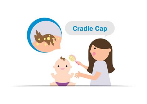 Cradle Cap Symptoms Causes Treatment And Prevention Richfeel