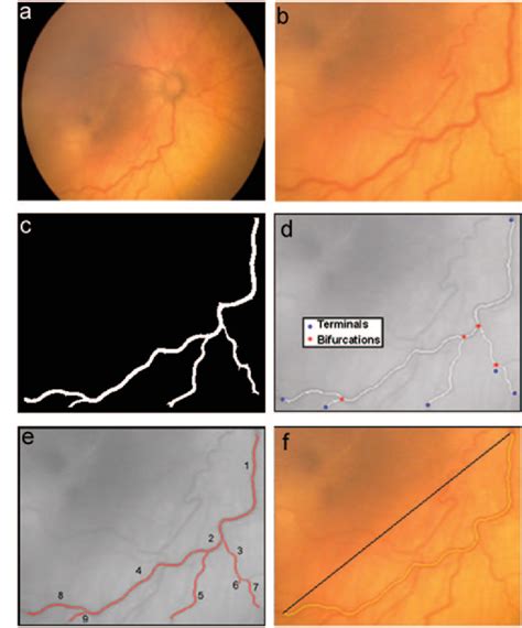 Figure From Diagnosis Of Plus Disease In Retinopathy Of Prematurity