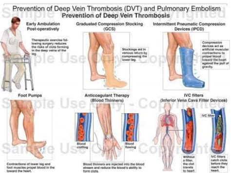 Dvt Deep Vein Thrombosis Ppt Free Download