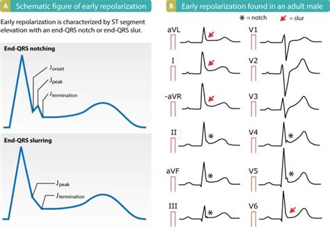 Figure 1. Early repolarization pattern on ECG. Note the end-QRS nothes ...