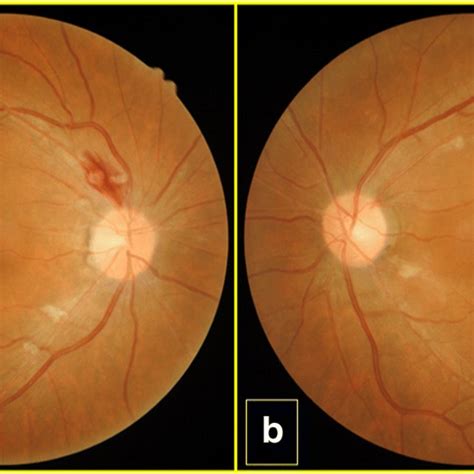 Mild Flame Shaped Hemorrhages Radiating From The Optic Disk A And Download Scientific Diagram