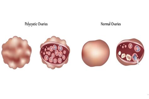 Polycystic Ovarian Syndrome PCOS Or Disease PCOD Treatment