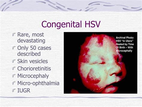 Ppt Neonatal Herpes Simplex Infections Powerpoint Presentation Free