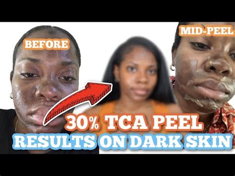 Best Diy At Home Tca Chemical Peel For Dark Skin W Before And