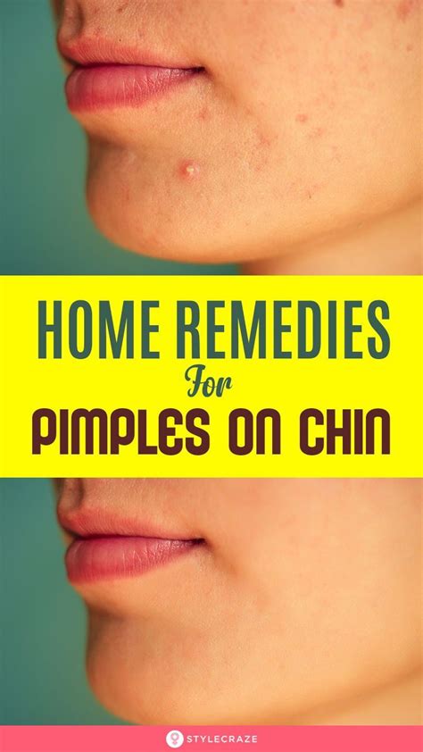 Chin Acne Pimples Causes Treatment And Skin Care Tips Artofit