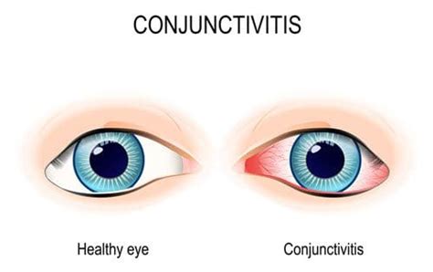 Conjunctivitis Pink Eye Causes And Real Treatments