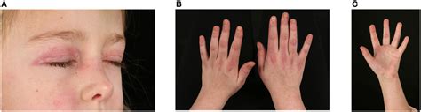 | Skin changes seen in juvenile dermatomyositis. (A) Heliotrope ...