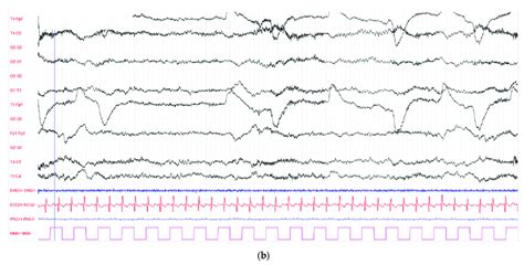 Electroencephalograms EEG Performed On The First And The Second Day