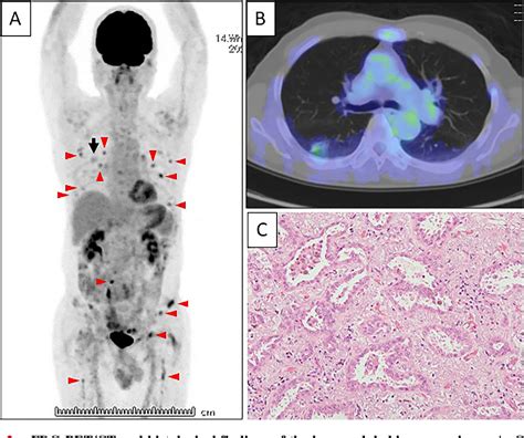 Figure 2 From Lung Adenocarcinoma With Chronic Lymphocytic Leukemia Mimicking Bone Metastasis