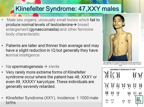 Medical Genetics Klinefelter Turner And Down Syndrome Lecture Ppt Video Online Download