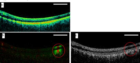 Figure From Doppler Optical Coherence Tomography For Choroidal