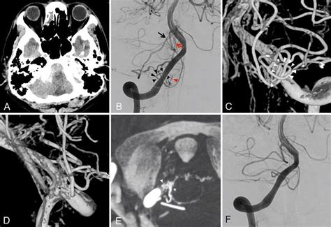 Case 2 A Ct Reveals Sah In The Right Cerebellomedullary Cistern B