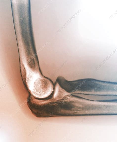 Normal Elbow Joint X Ray Stock Image C Science Photo Library