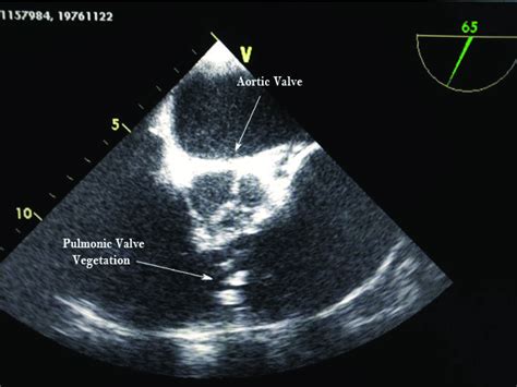 Mid Esophageal Short Axis View Showing Pulmonic Valve Vegetation