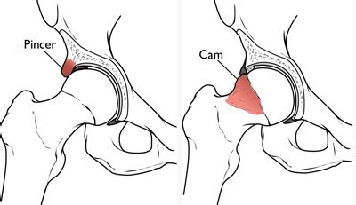 Femeroacetabular Impingement Genesis