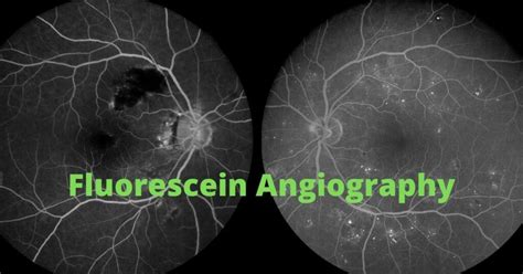 What Is A Fluorescein Angiogram Nader Moinfar Md Mph Facs Fasrs