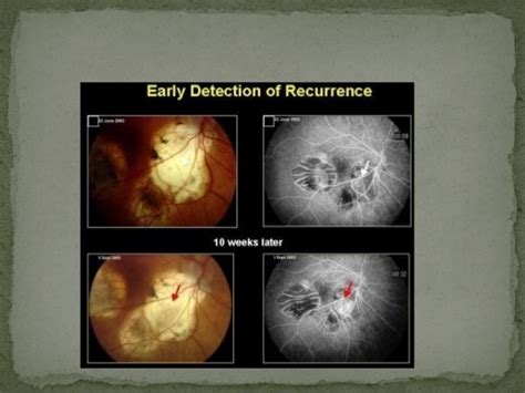 Retinoblastoma Rb