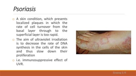 Ultraviolet Radiation In Physiotherapy Ppt