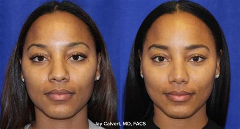 Rhinoplasty Beverly Hills Best Nose Job Dr Jay Calvert