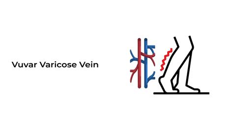 Vulvar Varicose Vein ~ Stat Cardiologist