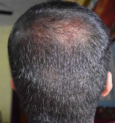 Is this normal to see blood on the scalp? This is after micro needling with 1.5 mm dermaroller ...