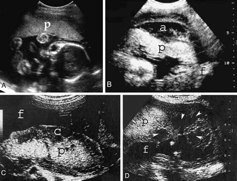 Varying Ultrasonographic Appearances Of Normal Placenta And Placental